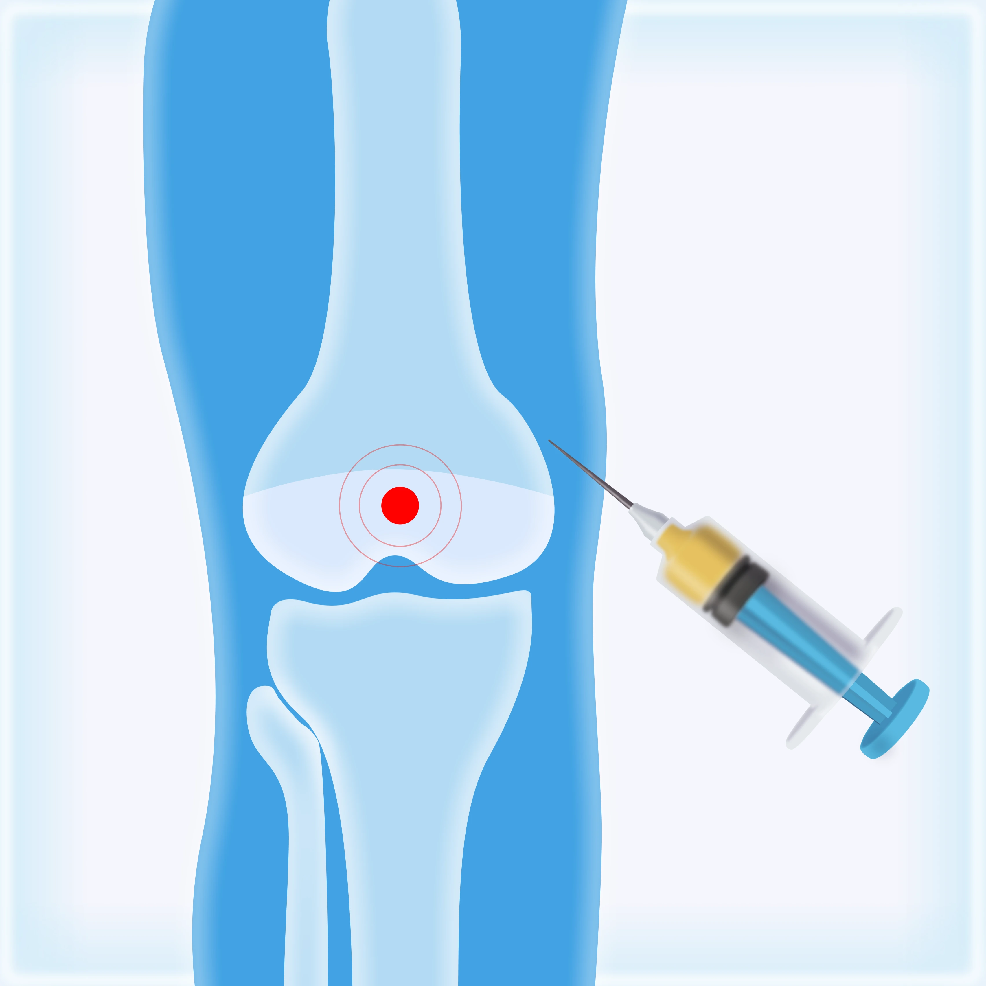 PRP Therapy for Osteoarthritis